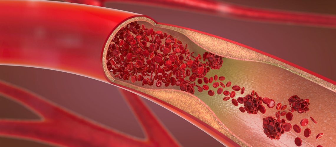 Pourquoi l’artère se fragilise avec l’âge ? Pourquoi l'artère se fragilise avec l'âge ?