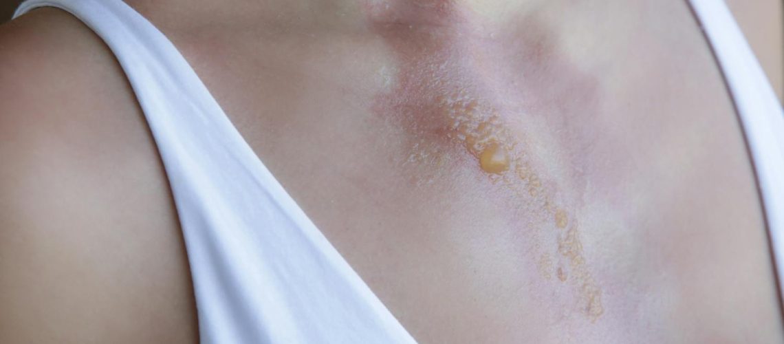 Brûlure qui suinte : comment la soigner ? c’est grave ? Brûlure qui suinte : comment la soigner ? c'est grave ?