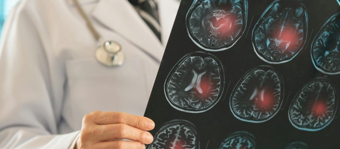 Ischémie : de quoi parle-t-on ? Ischémie : de quoi parle-t-on ?