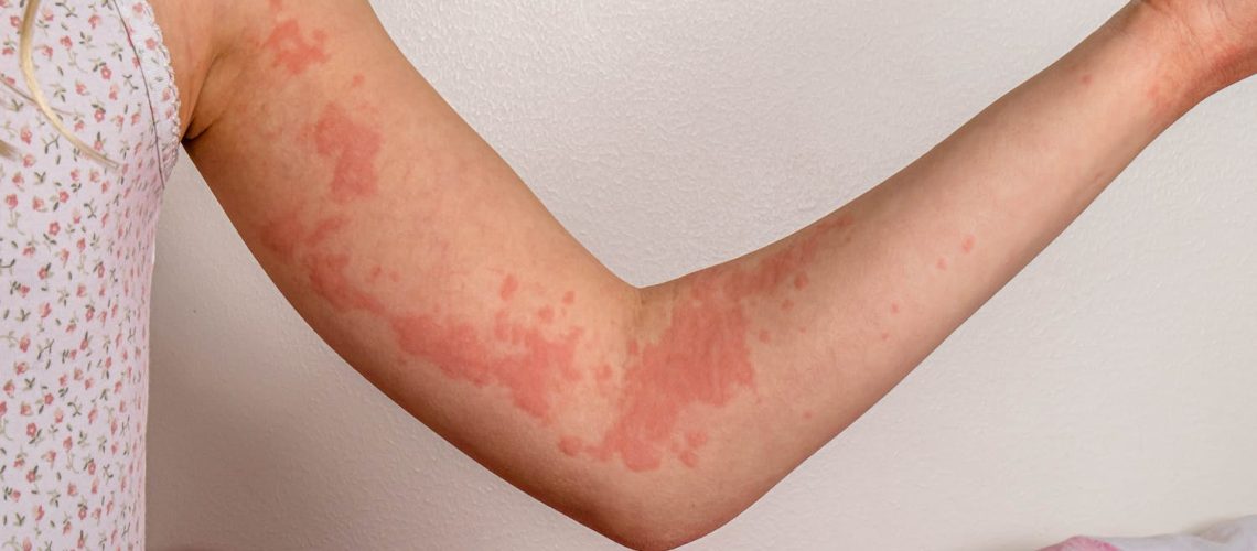 Peut-on faire une crise d’urticaire à cause du stress ? Peut-on faire une crise d'urticaire à cause du stress ?